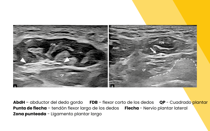 8. Musculatura intrinseca pie ecografia tempo formacion.png